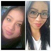 Lipo de mejillas y papada enzimática